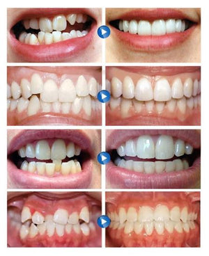 Plus Protections™️ Teeth Straightener